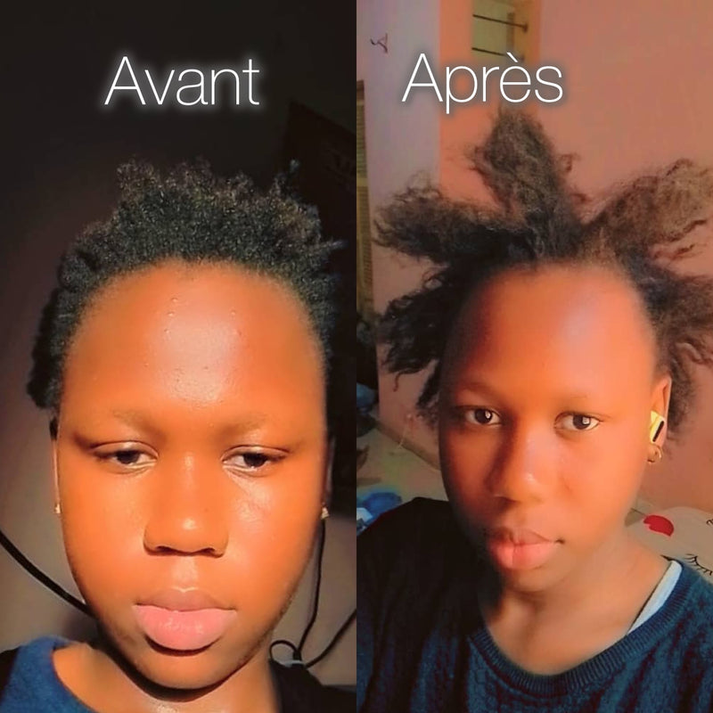 Chute de cheveux